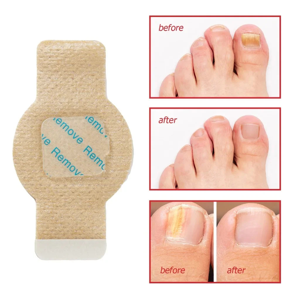 #1 Fungal Nail Patches 21 Pcs