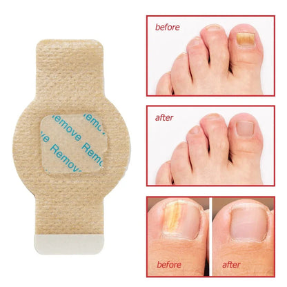 #1 Fungal Nail Patches 21 Pcs